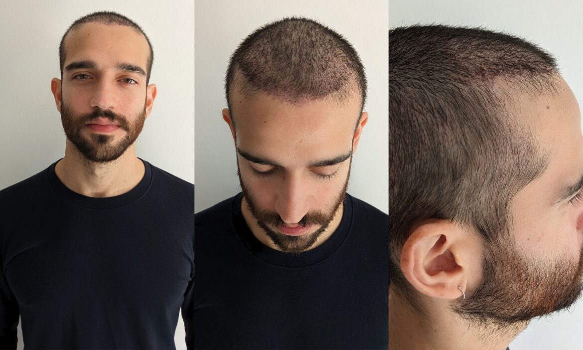 Comparing Hair Transplant Techniques Available Across the UK