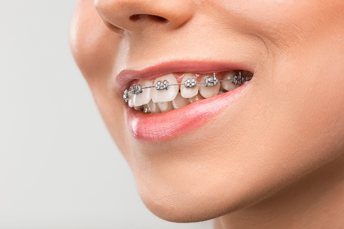 Where Can You Find the Best Price for Dental Braces in Singapore?